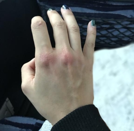 دست ضرب دیده این زن پس از ضربه شدید